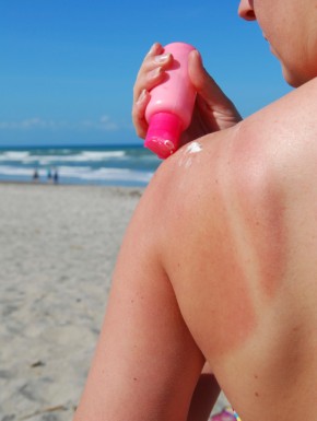 sunburn